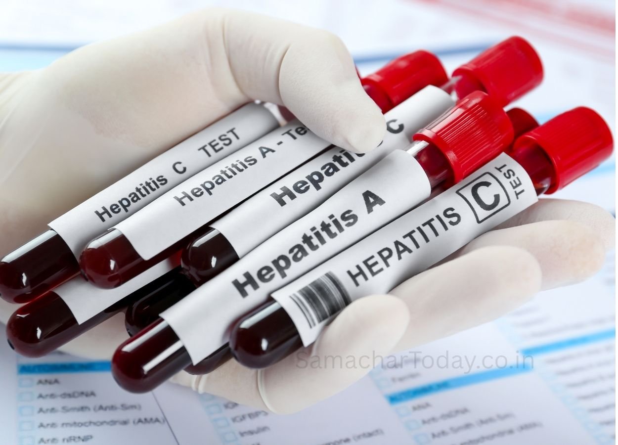 2030 तक हेपेटाइटिस खत्म करने की दिशा में तेज हुआ भारत का अभियान - SamacharToday.co.in
